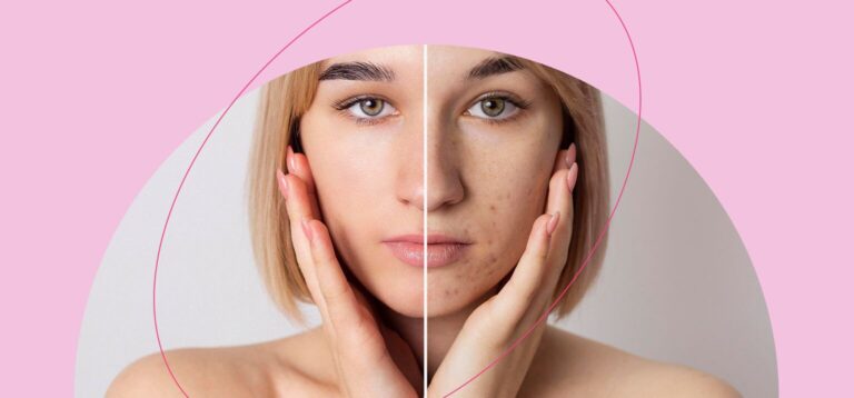 Comparação de pele com e sem acne em fundo rosa