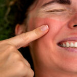 Mulher sorridente com a pele do rosto toda avermelhada, indicando que sua barreira cutânea pode estar danificada.
